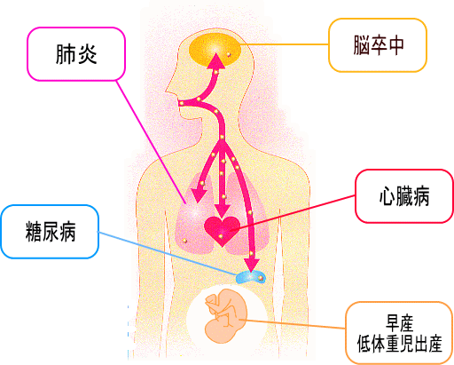 歯周病の原因菌が全身へ